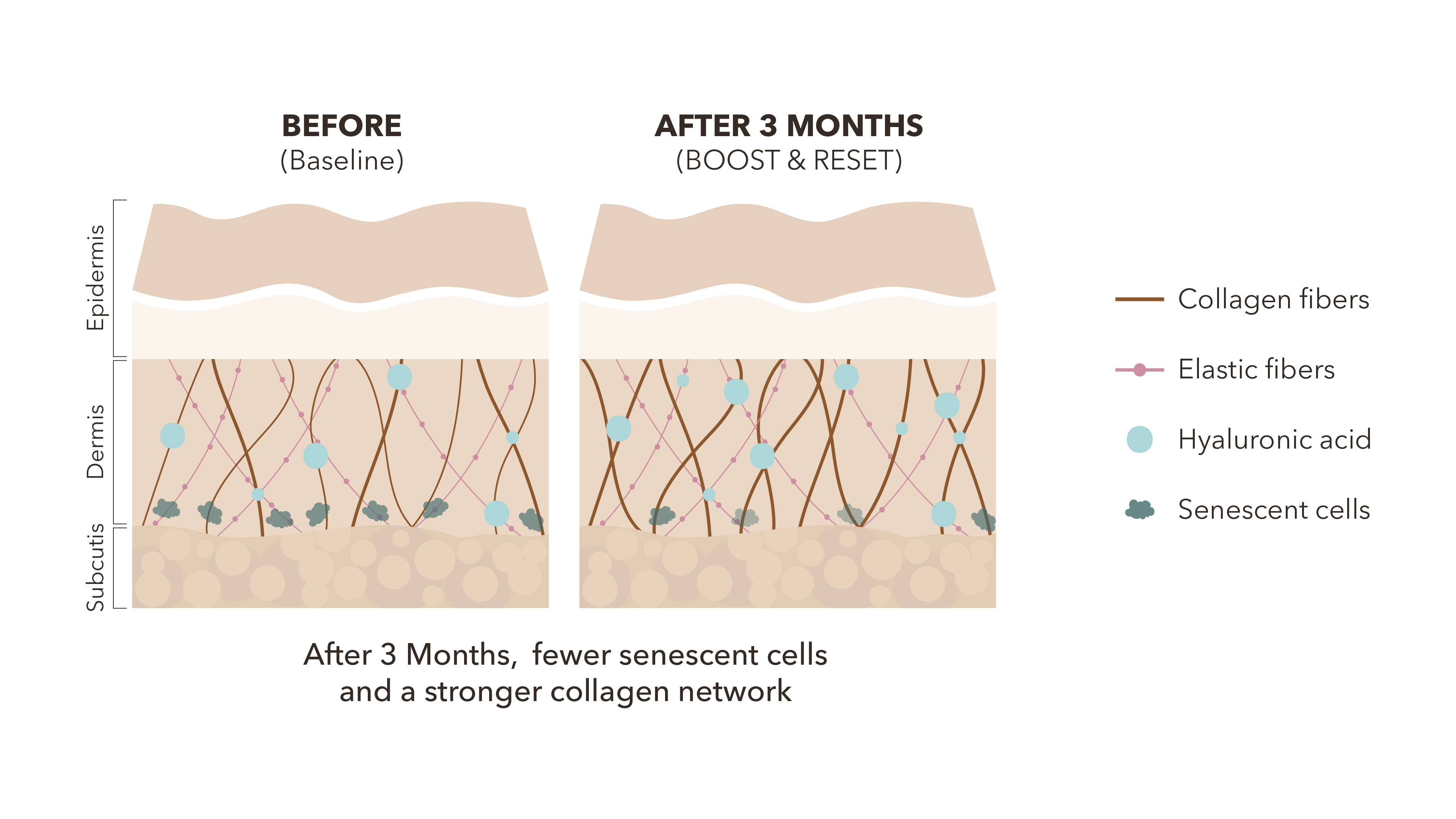 Illustration of skin layers showing fewer senescent cells and a denser collagen network after 3 months with BOOST + RESET.
Illustration av hudlager som visar färre senescenta celler och tätare kollagennätverk efter 3 månader med BOOST + RESET.
